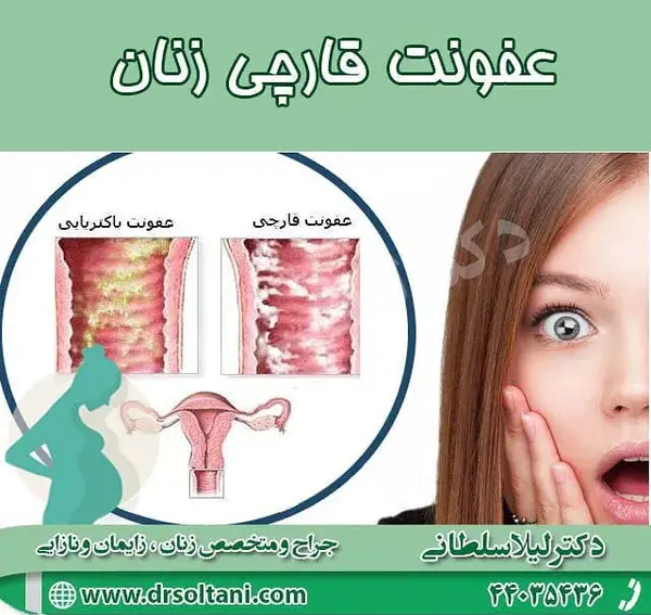 عکس عفونت قارچی داخل واژن