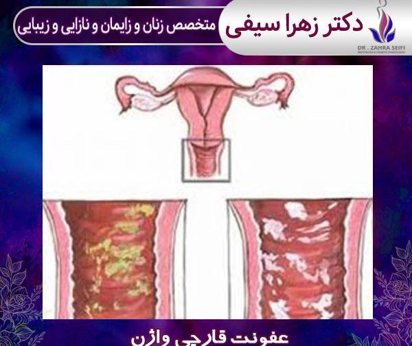 عکس عفونت قارچی داخل واژن