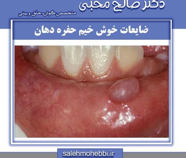 عکس داخل دهان انسان سالم