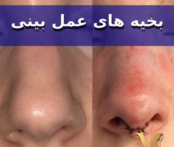 عکس بخیه داخل بینی