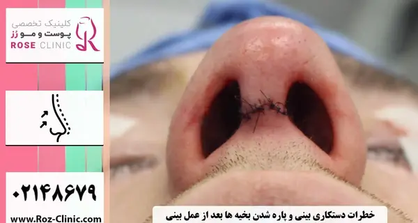 عکس بخیه داخل بینی