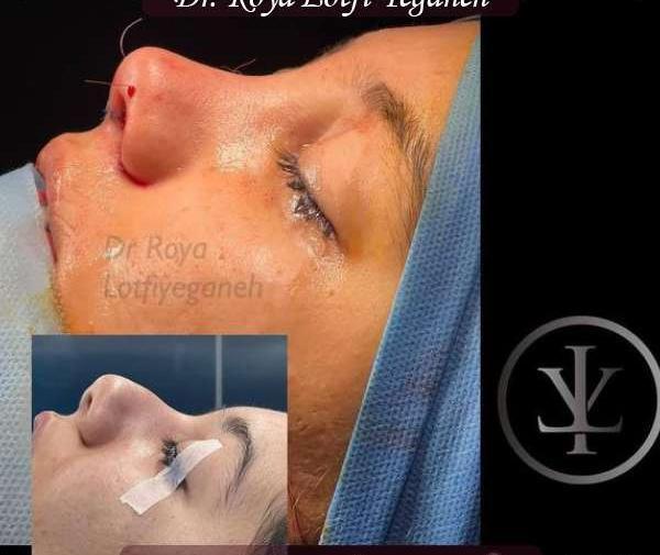 عکس بخیه داخل بینی