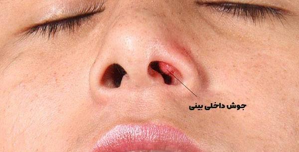 عکس بخیه داخل بینی