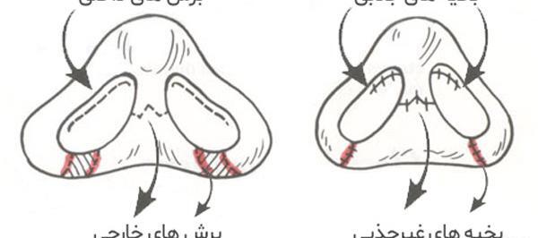 عکس بخیه داخل بینی