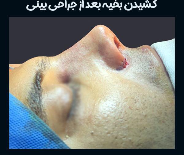 عکس بخیه داخل بینی