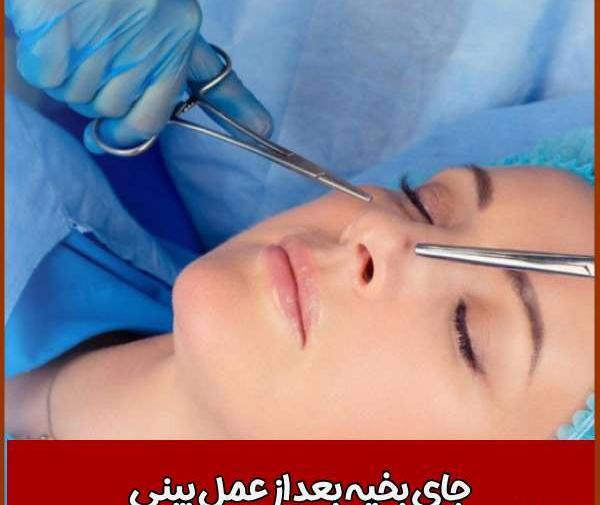 عکس بخیه داخل بینی