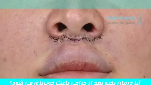 عکس بخیه داخل بینی
