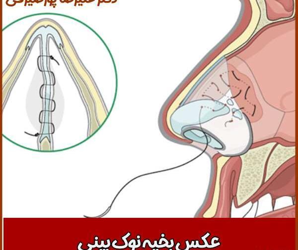 عکس بخیه داخل بینی