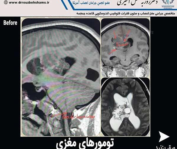 تومور عکس ام ار ای مغز سالم