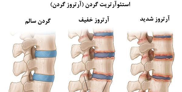 عکس ام ار ای گردن ناسالم