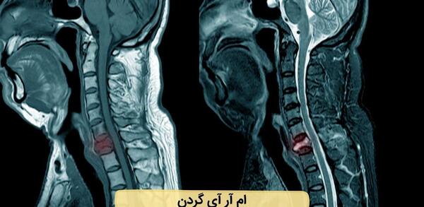 عکس ام ار ای دیسک کمر شدید