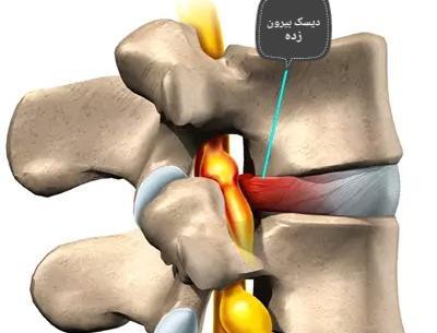 عکس ام ار ای دیسک کمر شدید