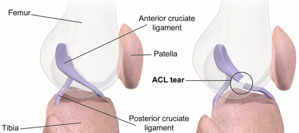 acl عکس ام ار ای پارگی رباط زانو