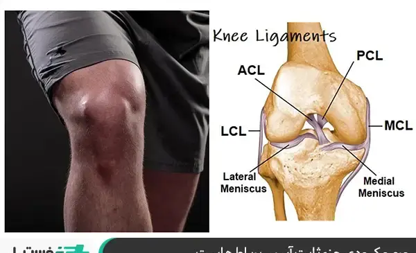acl عکس ام ار ای پارگی رباط زانو