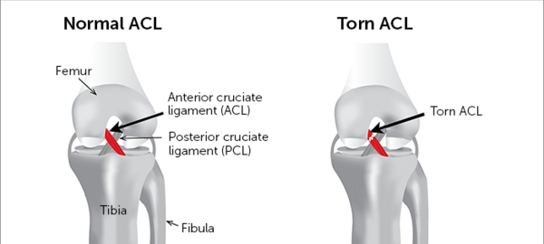 acl عکس ام ار ای پارگی رباط زانو