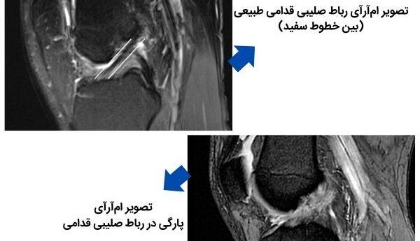 acl عکس ام ار ای پارگی رباط زانو