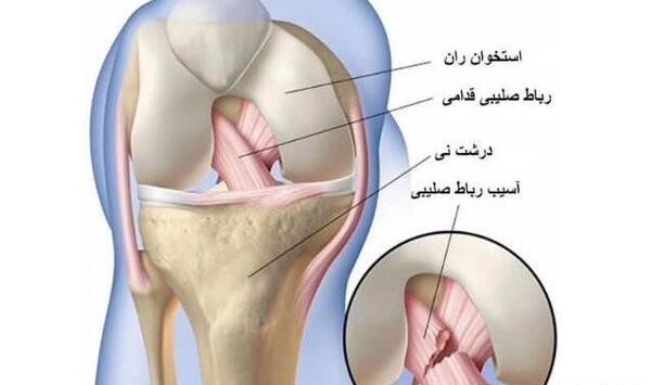 acl عکس ام ار ای پارگی رباط زانو