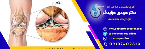 acl عکس ام ار ای پارگی رباط زانو