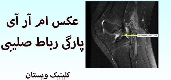 acl عکس ام ار ای پارگی رباط زانو