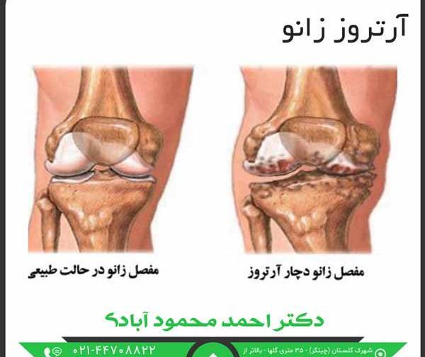 عکس ام آر آی زانو
