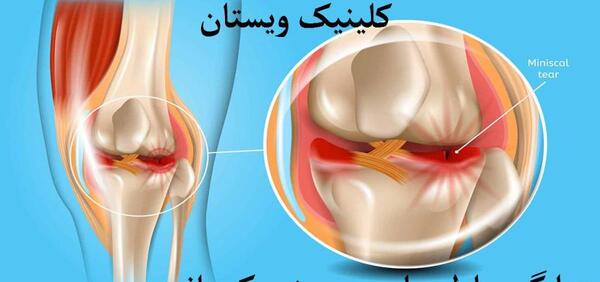 عکس ام ار ای رباط صلیبی سالم