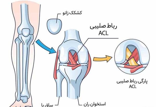 عکس ام ار ای رباط صلیبی سالم