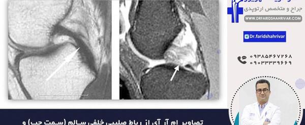 عکس ام ار ای رباط صلیبی سالم