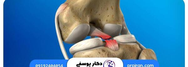 عکس ام ار ای رباط صلیبی سالم
