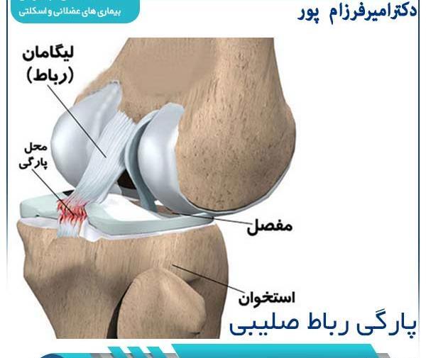 عکس ام ار ای رباط صلیبی پاره