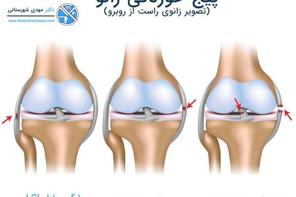عکس ام ار ای رباط صلیبی پاره شده