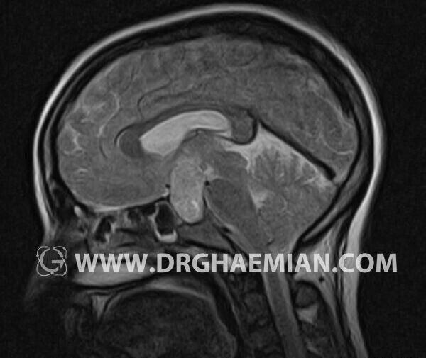 عکس ام ار ای هیپوفیز ناسالم
