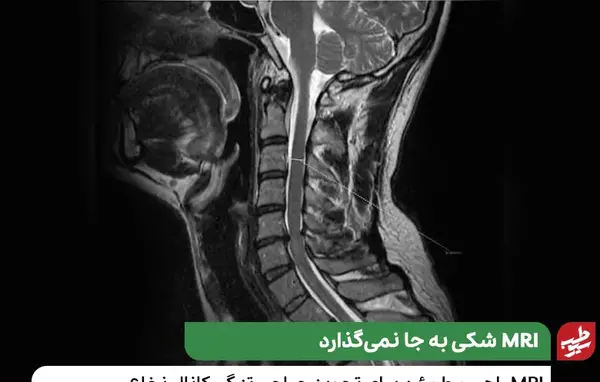 عکس ام ار ای تنگی نخاع