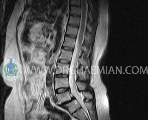 عکس نخاع سالم در ام ار ای