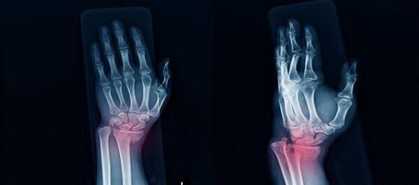 عکس ام ار ای مچ دست سالم