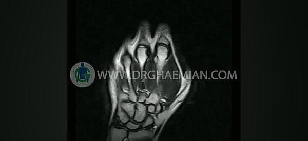 عکس ام ار ای مچ دست سالم