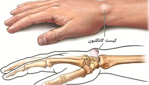 عکس ام ار ای مچ دست سالم