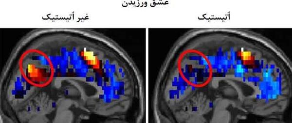 عکس ام اس در ام ار ای