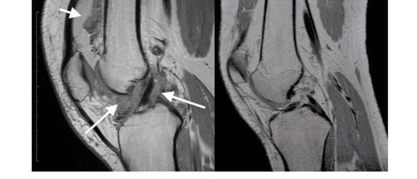 عکس ام ار ای کتف سالم