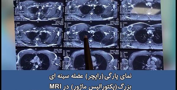 عکس ام ار ای کتف سالم