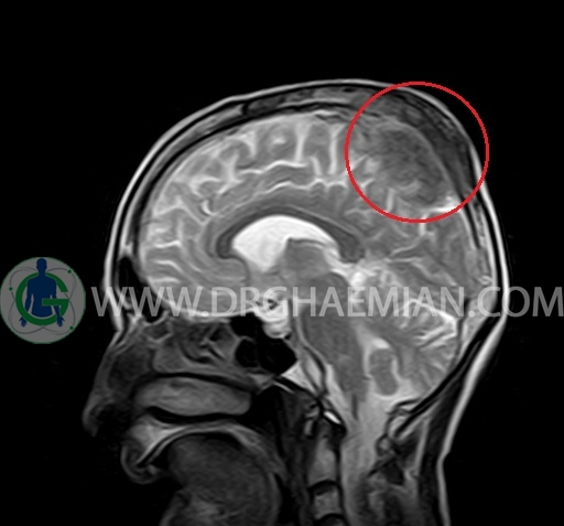 تفسیر عکس ام ار ای سر