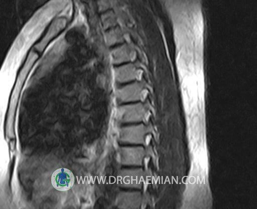 عکس ام آر آی ستون فقرات سالم