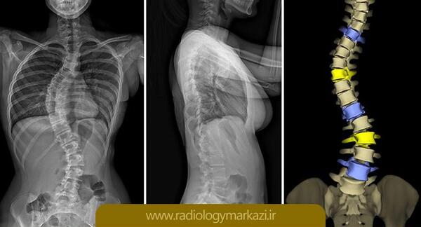 عکس ام آر آی ستون فقرات سالم