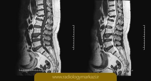 عکس ام ار ای ستون فقرات اسیب دیده
