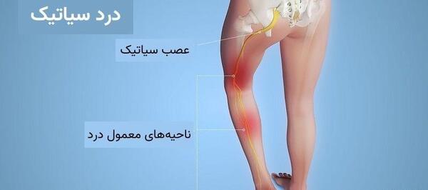 عکس ام ار ای عصب سیاتیک