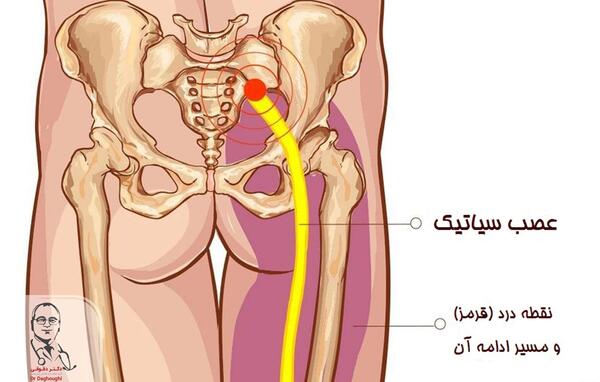 عکس ام ار ای عصب سیاتیک