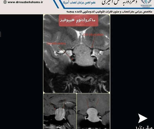 عکس غده هیپوفیز در ام ار ای