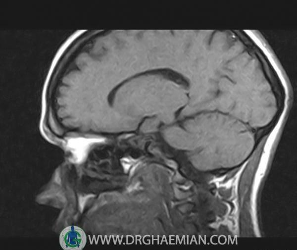 عکس غده هیپوفیز در ام ار ای