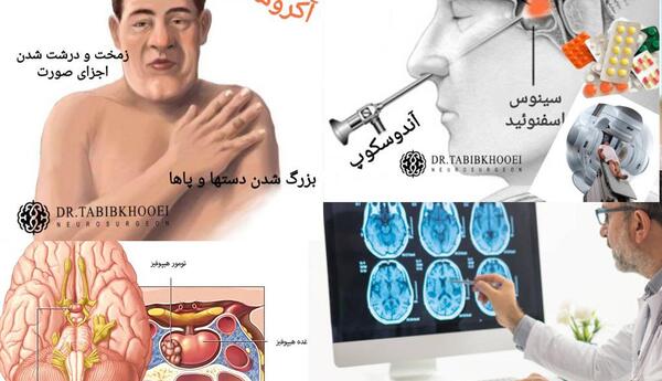 عکس غده هیپوفیز در ام ار ای