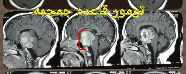 عکس غده هیپوفیز در ام ار ای