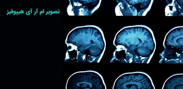 عکس غده هیپوفیز در ام ار ای